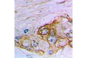 Immunohistochemical analysis of MUC16 staining in human bladder cancer formalin fixed paraffin embedded tissue section. (MUC16 antibody  (Center))