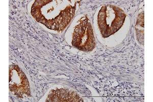 Immunoperoxidase of monoclonal antibody to SLC11A2 on formalin-fixed paraffin-embedded human endometrium cancer. (SLC11A2 antibody  (AA 1-65))
