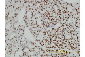 Immunoperoxidase of monoclonal antibody to ZNF143 on formalin-fixed paraffin-embedded human ovary, clear cell carcinoma tissue. (ZNF143 antibody  (AA 1-626))