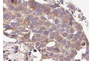 ABIN6267636 at 1/100 staining human breast carcinoma tissue sections by IHC-P. (G3BP1 antibody  (pSer232))