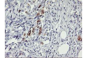 Immunohistochemical staining of paraffin-embedded Carcinoma of Human pancreas tissue using anti-SERPINB2 mouse monoclonal antibody. (SERPINB2 antibody)