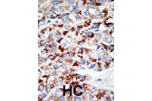 Formalin-fixed and paraffin-embedded human hepatocellular carcinoma tissue reacted with UBA3 polyclonal antibody  , which was peroxidase-conjugated to the secondary antibody, followed by DAB staining. (UBA3 antibody  (C-Term))