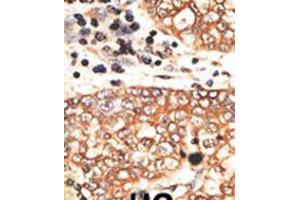 Formalin-fixed and paraffin-embedded human cancer tissue reacted with the primary antibody, which was peroxidase-conjugated to the secondary antibody, followed by AEC staining. (Neuregulin 2 antibody  (C-Term))