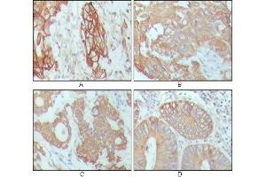 Immunohistochemical analysis of paraffin-embedded human breast carcinoma (A), hepatocarcinoma (B), stomach cancer (C) and colon cancer tissue (D), showing cytoplasmic location with DAB staining using CK18 mouse mAb.