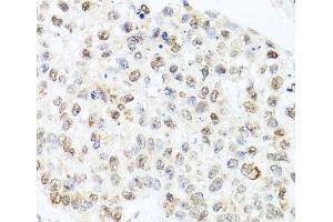 Immunohistochemistry of paraffin-embedded Human lung cancer using CETN3 Polyclonal Antibody at dilution of 1:100 (40x lens). (CETN3 antibody)