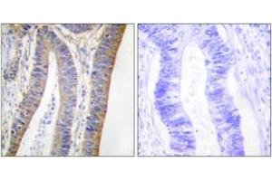 Immunohistochemistry analysis of paraffin-embedded human colon carcinoma, using p47 phox (Phospho-Ser359) Antibody. (NCF1 antibody  (pSer359))