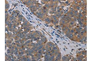 The image on the left is immunohistochemistry of paraffin-embedded Human ovarian cancer tissue using ABIN7191748(OTOR Antibody) at dilution 1/30, on the right is treated with synthetic peptide. (Otoraplin antibody)