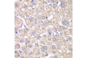Immunohistochemistry of paraffin-embedded human liver injury using ACAT1 antibody (ABIN6292593) at dilution of 1:100 (40x lens). (ACAT1 antibody)