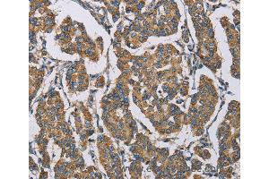 Immunohistochemistry of Human cervical cancer using HDAC6 Polyclonal Antibody at dilution of 1:50 (HDAC6 antibody)