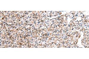 Immunohistochemistry of paraffin-embedded Human prost ate cancer tissue using DCAF7 Polyclonal Antibody at dilution of 1:30(x200) (DCAF7 antibody)