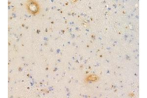 ABIN6256636 and ABIN6267635 at 1/100 staining human glioblastoma by IHC-P. (GRIN2B antibody  (pTyr1336))