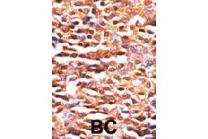 Formalin-fixed and paraffin-embedded human breast cancer tissue reacted with PPP2CA polyclonal antibody  , which was peroxidase-conjugated to the secondary antibody, followed by DAB staining. (PPP2CA antibody  (N-Term))