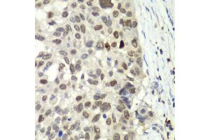 Immunohistochemistry of paraffin-embedded human esophageal cancer using E2F6 antibody. (E2F6 antibody)