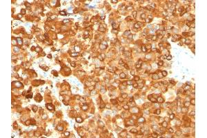 Formalin-fixed, paraffin-embedded human Melanoma stained with gp100 Mouse Monoclonal Antibody (PMEL/783).