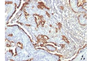 Formalin-fixed, paraffin-embedded human Lung Carcinoma stained with Cytokeratin 7 Monoclonal Antibody (KRT7/760 + OV-TL12/30) (Cytokeratin 7 antibody)