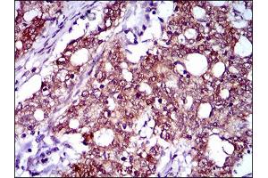 Immunohistochemical analysis of paraffin-embedded cervical cancer tissues using CFLAR mouse mAb with DAB staining. (FLIP antibody  (AA 100-251))