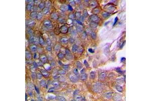 Immunohistochemical analysis of MMP10 staining in human prostate cancer formalin fixed paraffin embedded tissue section. (MMP10 antibody  (C-Term))