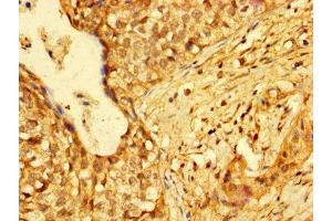 IHC image of ABIN7155213 diluted at 1:300 and staining in paraffin-embedded human cervical cancer performed on a Leica BondTM system. (HMGB3 antibody  (AA 1-103))