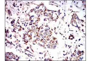 Immunohistochemical analysis of paraffin-embedded breast cancer tissues using PRKAG1 mouse mAb with DAB staining. (PRKAG1 antibody  (AA 230-331))