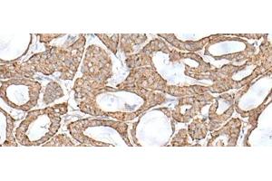 Immunohistochemistry of paraffin-embedded Human thyroid cancer tissue using RNF111 Polyclonal Antibody at dilution of 1:50(x200) (RNF111 antibody)