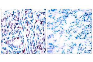 Immunohistochemistry (IHC) image for anti-Signal Transducer and Activator of Transcription 3 (Acute-Phase Response Factor) (STAT3) (pTyr705) antibody (ABIN1847534) (STAT3 antibody  (pTyr705))