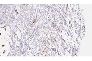 ABIN6273048 at 1/100 staining Human liver cancer tissue by IHC-P.
