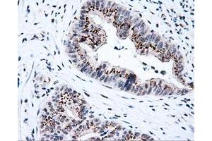 Immunohistochemical staining of paraffin-embedded Adenocarcinoma of colon tissue using anti-KIAA1609 mouse monoclonal antibody. (KIAA1609 antibody)