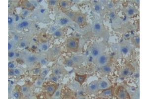 Detection of TNFR1 in Human Liver cancer Tissue using Polyclonal Antibody to Tumor Necrosis Factor Receptor 1 (TNFR1) (TNFRSF1A antibody  (AA 60-236))
