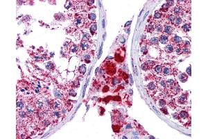 SFTPC antibody was used for immunohistochemistry at a concentration of 4-8 ug/ml. (Surfactant Protein C antibody  (N-Term))