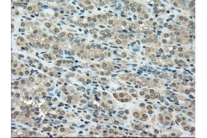 Immunohistochemical staining of paraffin-embedded Carcinoma of thyroid tissue using anti-SSBmouse monoclonal antibody. (SSB antibody)