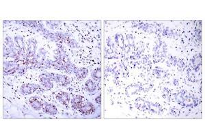 Immunohistochemical analysis of paraffin-embedded human breast carcinoma tissue using STAT4 (Ab-693) antibody (E021047). (STAT4 antibody)