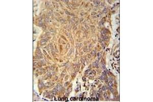 PCYXL Antibody (C-term) (ABIN651800 and ABIN2840404) immunohistochemistry analysis in formalin fixed and paraffin embedded human Lung carcinoma followed by peroxidase conjugation of the secondary antibody and DAB staining. (PCYOX1L antibody  (C-Term))