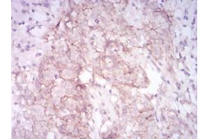 Immunohistochemical analysis of paraffin-embedded bladder cancer tissues using MMP14 mouse mAb with DAB staining.