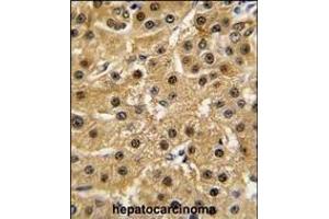 Formalin-fixed and paraffin-embedded human hepatocarcinoma tissue reacted with ABL1 antibody (Center), which was peroxidase-conjugated to the secondary antibody, followed by DAB staining. (ABL1 antibody  (AA 741-769))