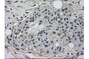 Immunohistochemical staining of paraffin-embedded Carcinoma of kidney tissue using anti-NEK6mouse monoclonal antibody. (NEK6 antibody)