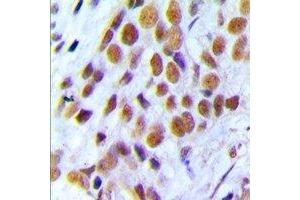 Immunohistochemical analysis of BRCA1 staining in human breast cancer formalin fixed paraffin embedded tissue section. (BRCA1 antibody  (C-Term))