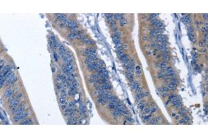 Immunohistochemistry of paraffin-embedded Human colon cancer using HSF27 Polyclonal Antibody at dilution of 1:60 (CDK5RAP3 antibody)
