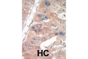 Formalin-fixed and paraffin-embedded human cancer tissue reacted with the primary antibody, which was peroxidase-conjugated to the secondary antibody, followed by DAB staining. (p21 antibody  (C-Term))