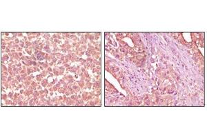 Immunohistochemical analysis of paraffin-embedded human skin carcinoma (left) and pancreas carcinoma (right) tissue, showing cytoplasmic localization using EphA2 mouse mAb with DAB staining. (EPH Receptor A2 antibody)