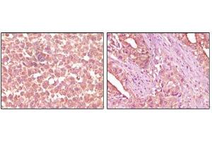Immunohistochemical analysis of paraffin-embedded human skin carcinoma (left) and pancreas carcinoma (right) tissue, showing cytoplasmic localization using EphA2 mouse mAb with DAB staining.
