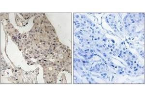 Immunohistochemistry analysis of paraffin-embedded human breast carcinoma, using Gab2 (Phospho-Ser623) Antibody. (GAB2 antibody  (pSer623))