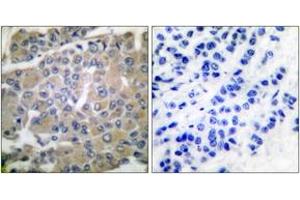 Immunohistochemistry analysis of paraffin-embedded human breast carcinoma tissue, using MMP-8 Antibody.