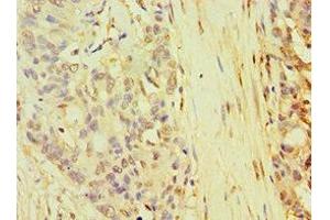 Immunohistochemistry of paraffin-embedded human endometrial cancer using ABIN7168268 at dilution of 1:100