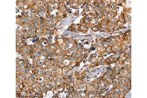 Immunohistochemistry of Human breast cancer using PPOX Polyclonal Antibody at dilution of 1:40 (PPOX antibody)
