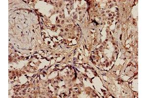 Immunohistochemistry analysis of human breast cancer using ABIN7150239 at dilution of 1:100 (POLE antibody  (Catalytic Subunit A))