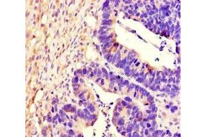 Immunohistochemistry of paraffin-embedded human ovarian cancer using ABIN7167518 at dilution of 1:100 (PTPRS antibody  (AA 25-128))