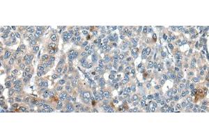 Immunohistochemistry of paraffin-embedded Human liver cancer tissue using CAPN3 Polyclonal Antibody at dilution of 1:30(x200) (Calpain 3 antibody)