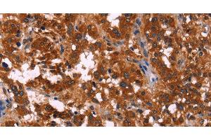 Immunohistochemistry of paraffin-embedded Human thyroid cancer using RPSA Polyclonal Antibody at dilution of 1:60 (RPSA/Laminin Receptor antibody)