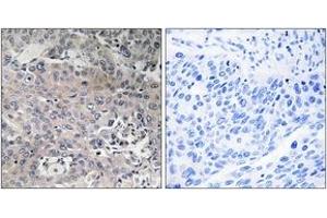 Immunohistochemistry analysis of paraffin-embedded human breast carcinoma tissue, using TUFM Antibody. (TUFM antibody  (AA 301-350))