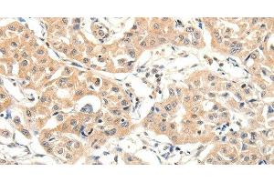 Immunohistochemistry of paraffin-embedded Human lung cancer tissue using SLC27A1 Polyclonal Antibody at dilution 1:40 (SLC27A1 antibody)